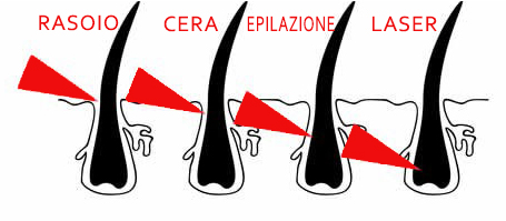 Laser per epilazione definitiva: come funziona e controindicazioni